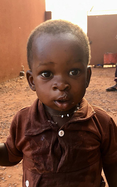 Enfant ayant bénéficié d'une opération de chirurgie réparatrice au Mali