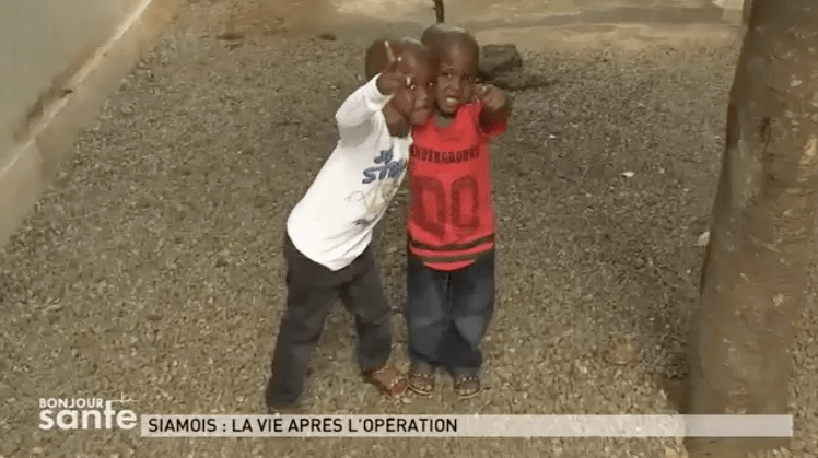 Bebes Siamois 3 Ans Apres La Chaine De L Espoir