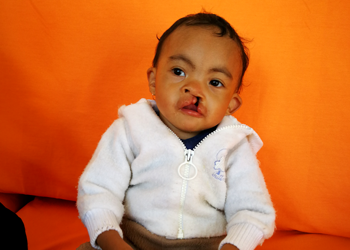 Mariela, open-heart surgery in Madagascar